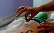 Facts about Acupuncture London