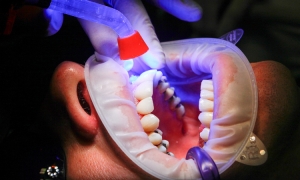 W jakich sytuacjach warto wybrać implanty zębowe?