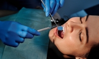 Lakowanie zębów - na czym polega, ile trwa i ile kosztuje?