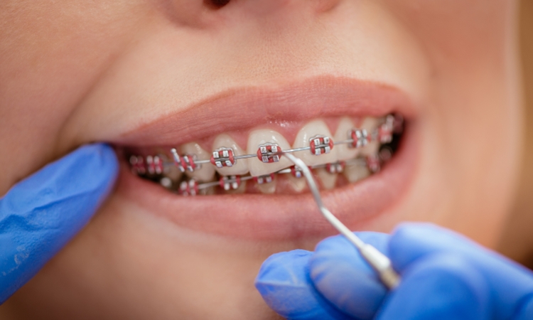 Leczenie ortodontyczne