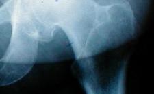 Experts Warn of Dangers from Hip Replacement Devices
