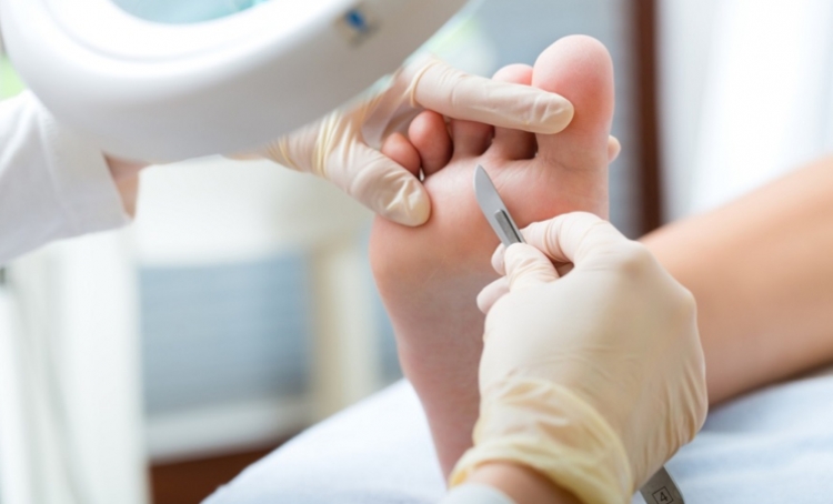 Laserowe leczenie grzybicy paznokci